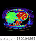 CT scan showing right ventricular strain in a patient with pulmonary embolism, highlighting right ventricular enlargement and flattening of the interventricular septum 130104865