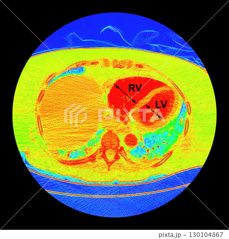CT scan showing right ventricular strain in a patient with pulmonary embolism, highlighting right ventricular enlargement and flattening of the interventricular septum CT scan showing right ventricular strain in a patient with pulmonary embolism, highlighting right ventricular enlargement and flattening of the interventricular septum 130104867