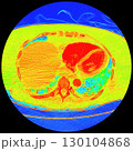 CT scan showing right ventricular strain in a patient with pulmonary embolism, highlighting right ventricular enlargement and flattening of the interventricular septum 130104868