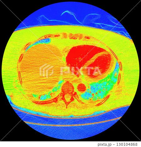 CT scan showing right ventricular strain in a patient with pulmonary embolism, highlighting right ventricular enlargement and flattening of the interventricular septum CT scan showing right ventricular strain in a patient with pulmonary embolism, highlighting right ventricular enlargement and flattening of the interventricular septum 130104868