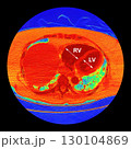 CT scan showing right ventricular strain in a patient with pulmonary embolism, highlighting right ventricular enlargement and flattening of the interventricular septum 130104869