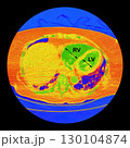 CT scan showing right ventricular strain in a patient with pulmonary embolism, highlighting right ventricular enlargement and flattening of the interventricular septum 130104874