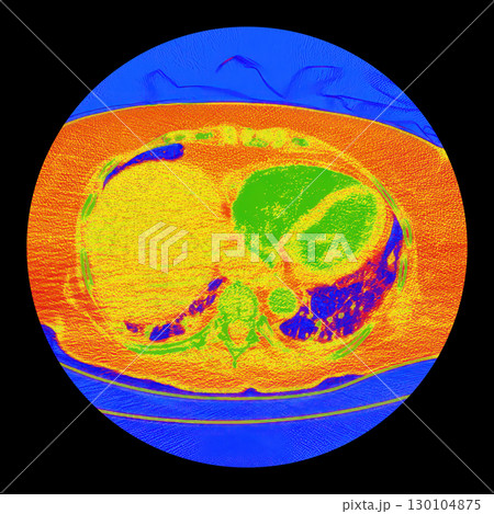 CT scan showing right ventricular strain in a patient with pulmonary embolism, highlighting right ventricular enlargement and flattening of the interventricular septum 130104875