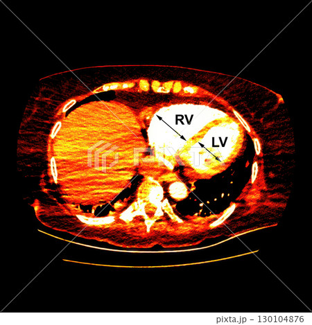 CT scan showing right ventricular strain in a patient with pulmonary embolism, highlighting right ventricular enlargement and flattening of the interventricular septum 130104876