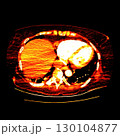 CT scan showing right ventricular strain in a patient with pulmonary embolism, highlighting right ventricular enlargement and flattening of the interventricular septum 130104877