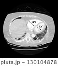 CT scan showing right ventricular strain in a patient with pulmonary embolism, highlighting right ventricular enlargement and flattening of the interventricular septum 130104878