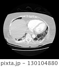 CT scan showing right ventricular strain in a patient with pulmonary embolism, highlighting right ventricular enlargement and flattening of the interventricular septum 130104880