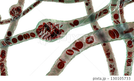 Microaneurysms, microscopic buldges in the artery walls filled with blood 130105733