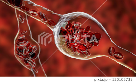 Microaneurysms, microscopic buldges in the artery walls filled with blood Microaneurysms, microscopic buldges in the artery walls filled with blood 130105735