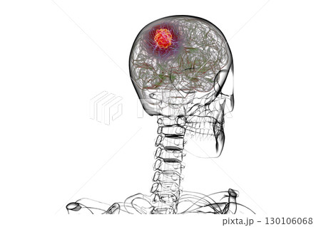 Brain tumor, 3D illustration 130106068