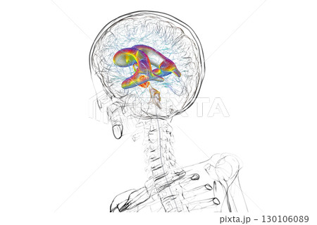 A brain tumor causing hydrocephalus, 3D illustration 130106089