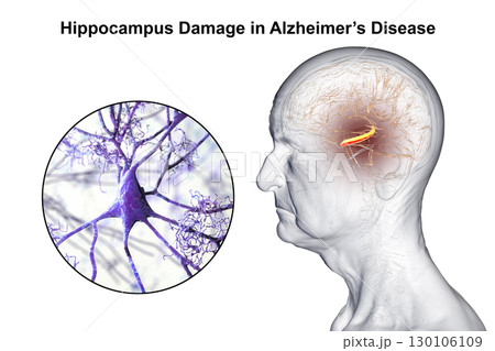 Alzheimer's disease, 3D illustration 130106109
