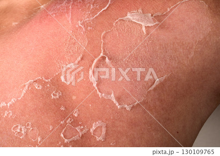 Close-Up of Peeling Sunburned Skin on Shoulder Showing Damage and Natural Healing Process 130109765