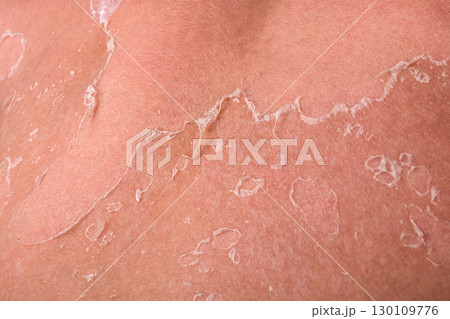 Close-Up of Peeling Skin on Back After Sunburn, Showing Healing Process and Sun Damage Close-Up of Peeling Skin on Back After Sunburn, Showing Healing Process and Sun Damage 130109776