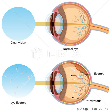 Comparison of Normal Eye and Eye Floaters Illustration 130122065