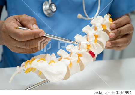 Asian doctor holding spinal nerve and bone model, Lumbar spine displaced herniated disc fragment for treatment medical in the orthopedic department. 130135994