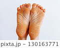 cracked peeling skin on woman's feet 130163771