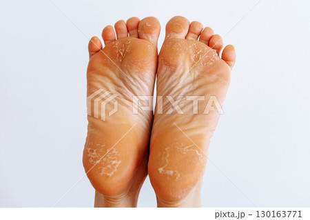 cracked peeling skin on woman's feet 130163771