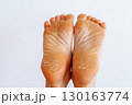 cracked peeling skin on woman's feet 130163774