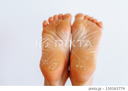 cracked peeling skin on woman's feet 130163774