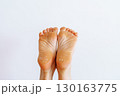 cracked peeling skin on woman's feet 130163775