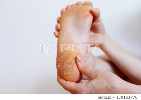 cracked peeling skin on woman's feet 130163776
