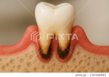 歯周病  歯肉や歯茎が赤く腫れている様子 130166065