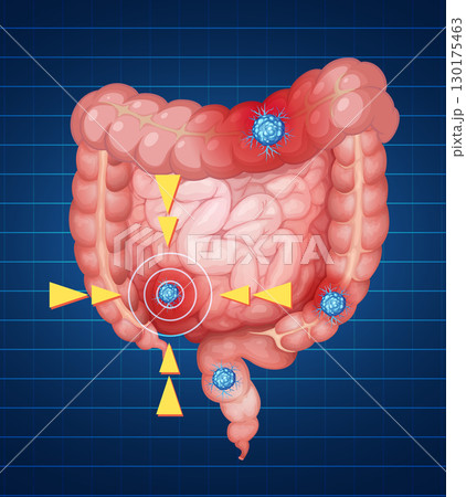 Detailed Vector Illustration of Cancer Cells in Intestines 130175463