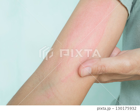 Hand with Urticaria Allergy Itchy Rash Eczema Itch Woman from Food,Air Poisoning,Cosmetic,Health,Body Care Disease Lilness Air,Dissease Medicine Calamine Lotion Treatment ,Infection Pain Sick Scratch. Hand with Urticaria Allergy Itchy Rash Eczema Itch Woman from Food,Air Poisoning,Cosmetic,Health,Body Care Disease Lilness Air,Dissease Medicine Calamine Lotion Treatment ,Infection Pain Sick Scratch. 130175932