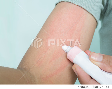 Hand with Urticaria Allergy Itchy Rash Eczema Itch Woman from Food,Air Poisoning,Cosmetic,Health,Medicine Body Care Disease Lilness Air,Dissease She Apply Calamine drug Treatment ,Infection Pain. 130175933