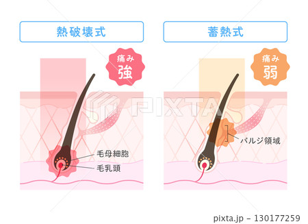 レーザー脱毛、熱破壊式・蓄熱式の比較イラスト 130177259