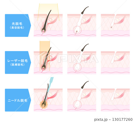 脱毛の施術方法、エステ脱毛・医療用レーザー脱毛・ニードル脱毛 脱毛の施術方法、エステ脱毛・医療用レーザー脱毛・ニードル脱毛 130177260