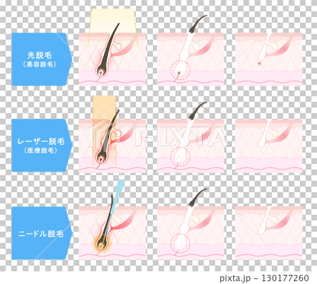 脱毛の施術方法、エステ脱毛・医療用レーザー脱毛・ニードル脱毛 脱毛の施術方法、エステ脱毛・医療用レーザー脱毛・ニードル脱毛 130177260