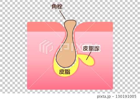 毛穴に角栓が詰まっている様子を示した図解イラスト 130191005