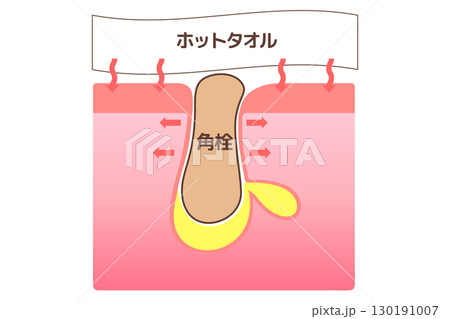 角栓の詰まった毛穴をホットタオルで温めて開きやすくしている図解イラスト 130191007