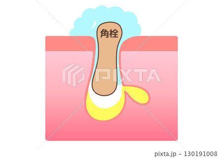 洗顔時に角栓が抜ける様子を表した断面イラスト 130191008