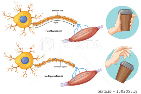 Comparison of Healthy Neuron and Multiple Sclerosis Effects 130205518