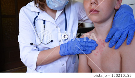 The boy's body displays signs of monkeypox infection. 130210153