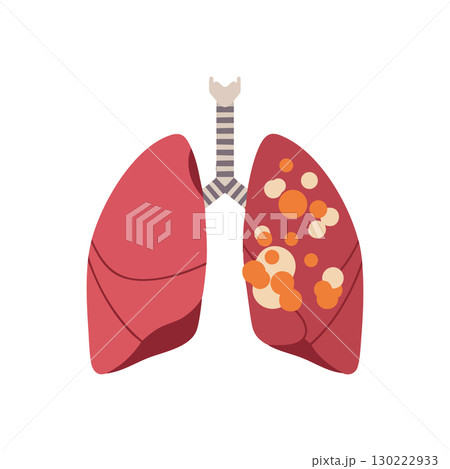 Human lungs illustration with lung disease infection vector medical concept 130222933