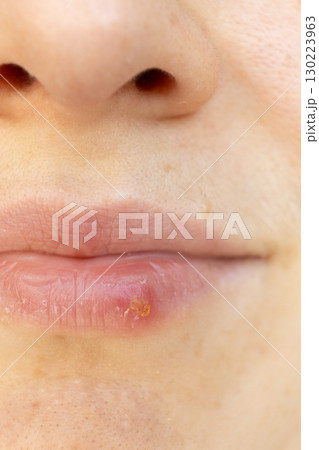 Macro Closeup of Herpes on Human Lip. 130223963