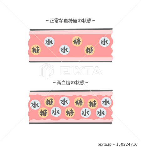 正常な血糖値の血管と高血糖状態の血管の比較イラスト_パステル 130224716