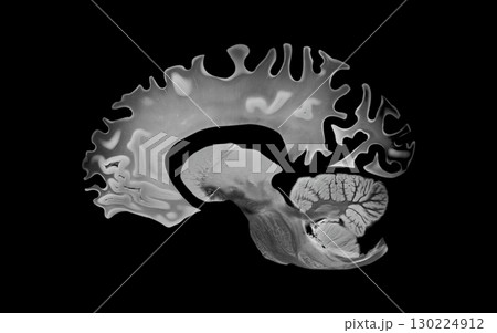 Sagittal Brain View Showing Atrophy from Alzheimer Disease Sagittal Brain View Showing Atrophy from Alzheimer Disease 130224912