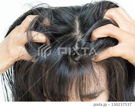 Dandruff Hair Scalp Sebum Woman Close up, Fungus Skin Itch Head Problem Trouble Dirty Dry Scratch Seborrhea, Asian Brown Hair. 130237537