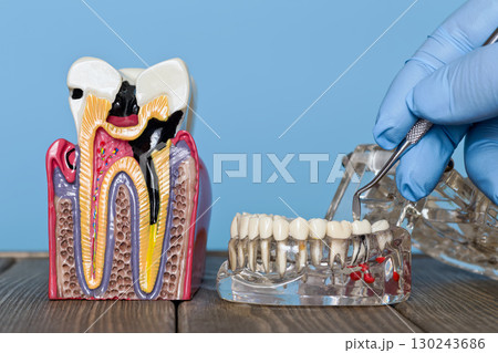 Dental decay model and jaw examination with explorer 130243686