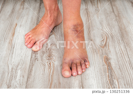 injured swollen female foot with hematomas, close-up injured swollen female foot with hematomas, close-up 130251336