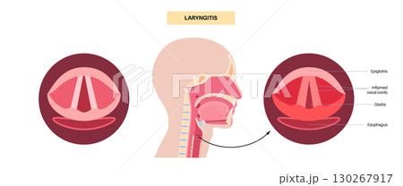 Epiglottitis medical poster Epiglottitis medical poster 130267917