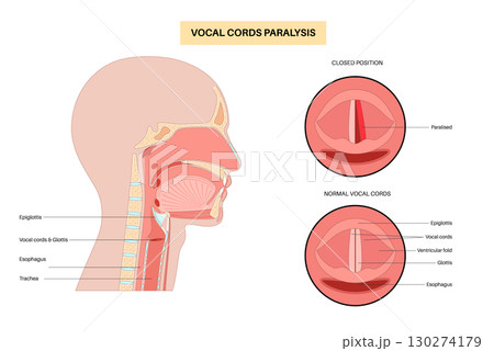 Vocal cords paralysis Vocal cords paralysis 130274179