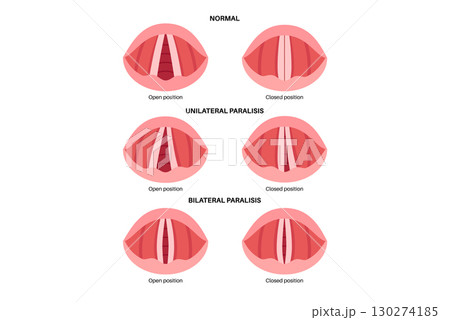 Vocal cords paralysis Vocal cords paralysis 130274185