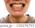 リテーナーを付ける女性 130276755