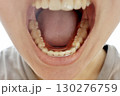 リテーナーの裏側 130276759